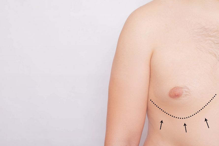 Gynecomastia Surgery Antalya