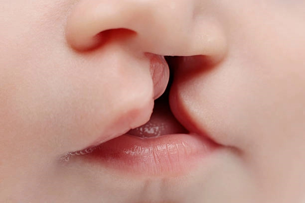 Cleft | Antalya Plastic Surgery