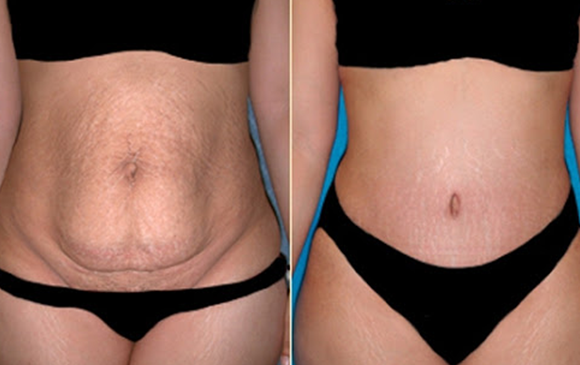 Body Lift | Antalya Plastic Surgery
