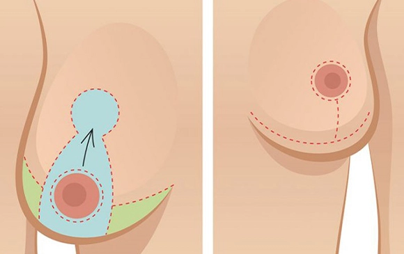 Breast Reductıon | Antalya Plastic Surgery