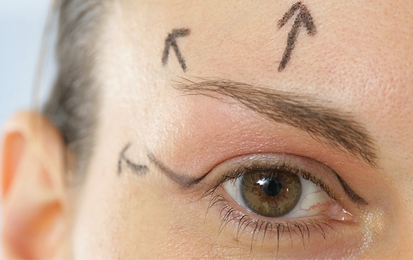 Brow Lift | Antalya Plastic Surgery