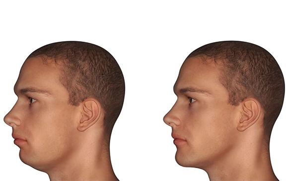 Chin Augementatıon | Antalya Plastic Surgery
