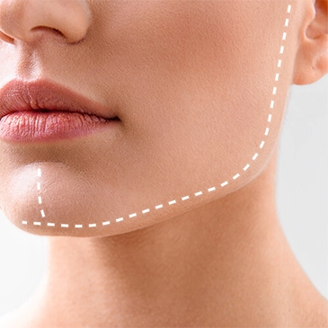 Chin Augementatıon | Antalya Plastic Surgery