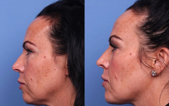 Face Reconstruction | Antalya Plastic Surgery