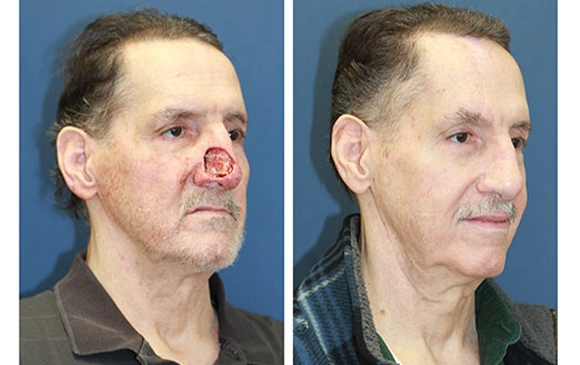 Face Reconstruction | Antalya Plastic Surgery