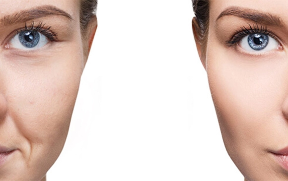 Fat Grafting | Plastic Surgery Antalya