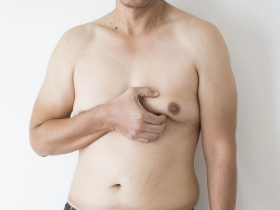 Gynecomastia | Plastic Surgery Antalya