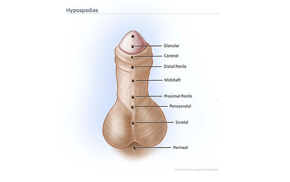 Hypospadias | Antalya Plastic Surgery