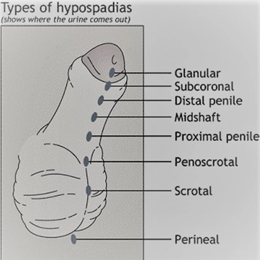 Hypospadias | Antalya Plastic Surgery
