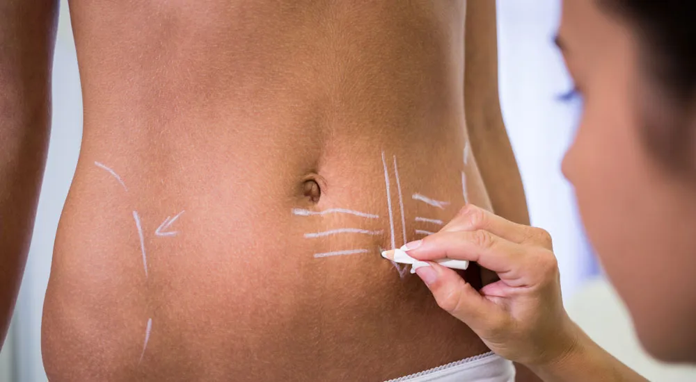 Liposuctıon | Plastic Surgery Antalya