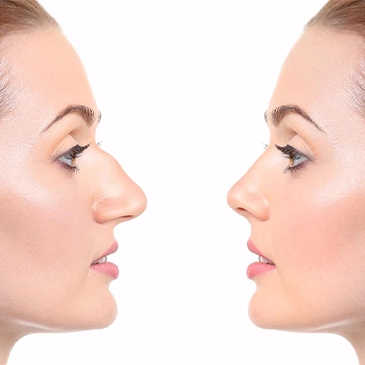 Rhinoplasty | Plastic Surgery Antalya