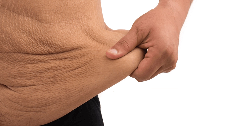 Post Bariatric | Plastic Surgery Antalya