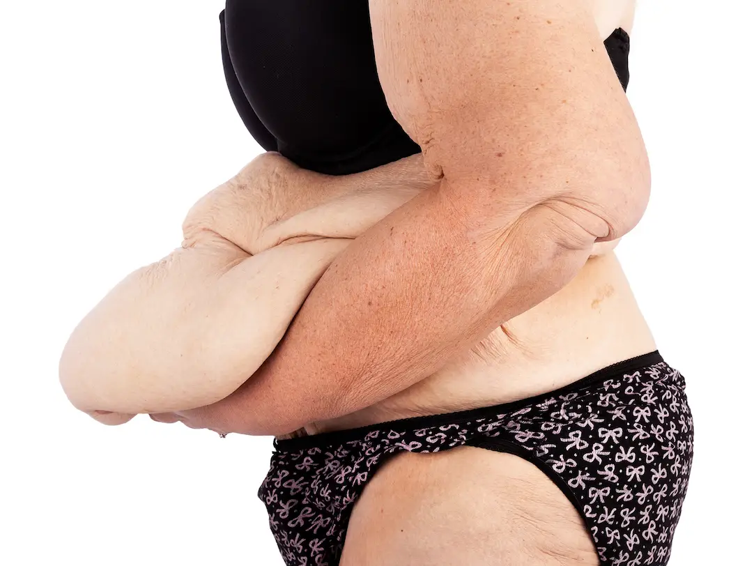 Post Bariatric | Plastic Surgery Antalya