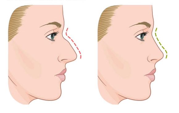 Revision Rhinoplasty | Plastic Surgery Antalya