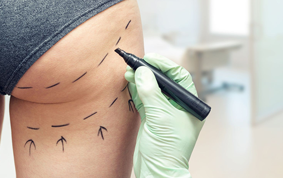 A thigh lift antalya | Plastic surgery