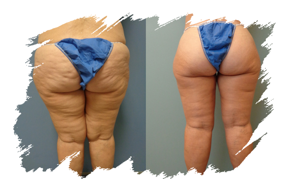 a-thigh-lift-antalya.png