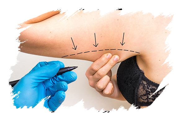 an-upper-arm-lift-plastic-surgery-antalya.png