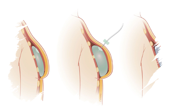 breast-augementation-antalya-plastic-surgery.png