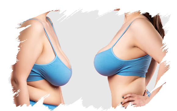 breast-lift-price-turkey-breast-lift-antalya-plastic-surgery.png