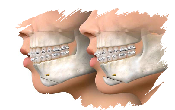 Chin Augementatıon | Antalya Plastic Surgery