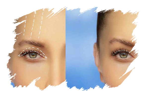 eyelid-surgery-antalya-plastic-surgery.png