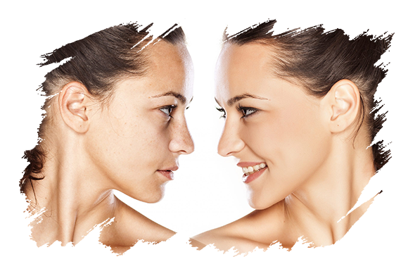 fat-grafting-antalya-plastic-surgery.png