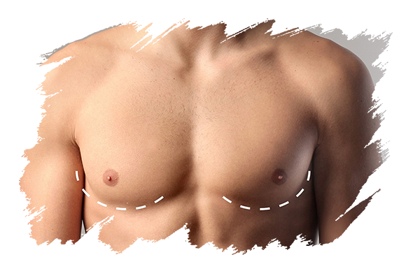 Gynecomastia | Plastic Surgery Antalya