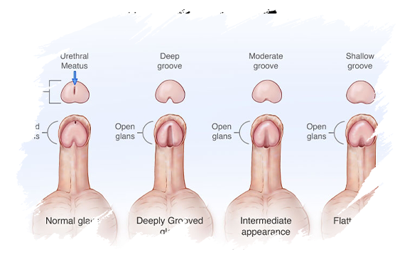 Hypospadias | Antalya Plastic Surgery