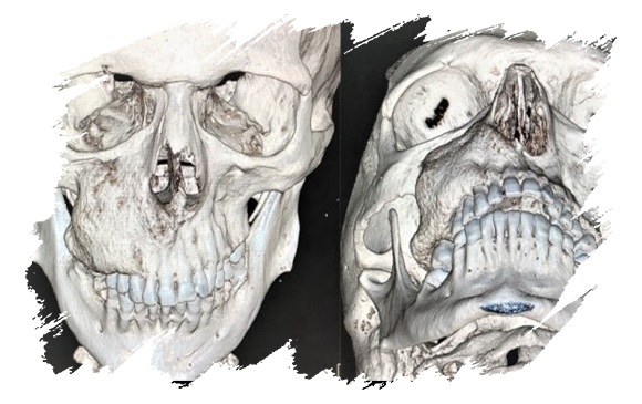 Jaw Tumors | Antalya Plastic Surgery