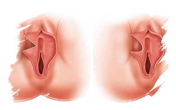 labiaplasty-antalya-plastic-aurgery.png