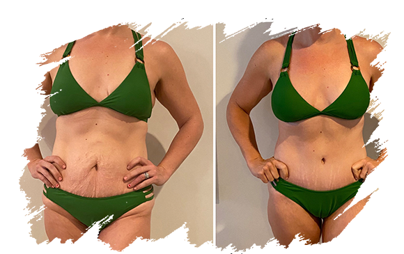 mommy-makeover-plastic-surgery-antalya.png