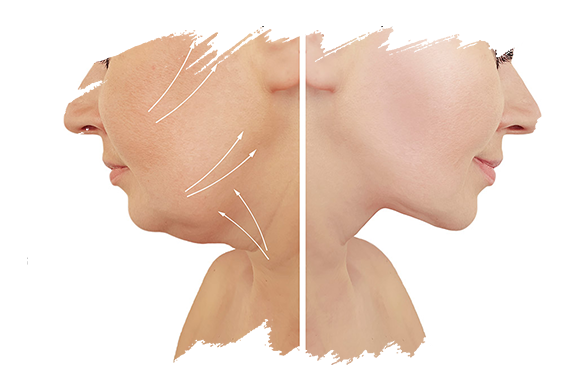 Necklift | Plastic Surgery Antalya