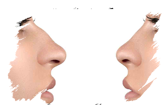 Rhinoplasty | Plastic Surgery Antalya