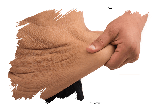 Post Bariatric | Plastic Surgery Antalya