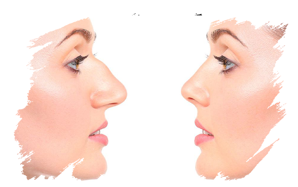 Revision Rhinoplasty | Plastic Surgery Antalya