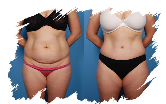 tummy-tuck-plastic-surgery-antalya.png